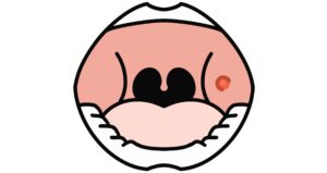 口内炎には様々な種類がある