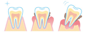 歯周病の見分け方を知る